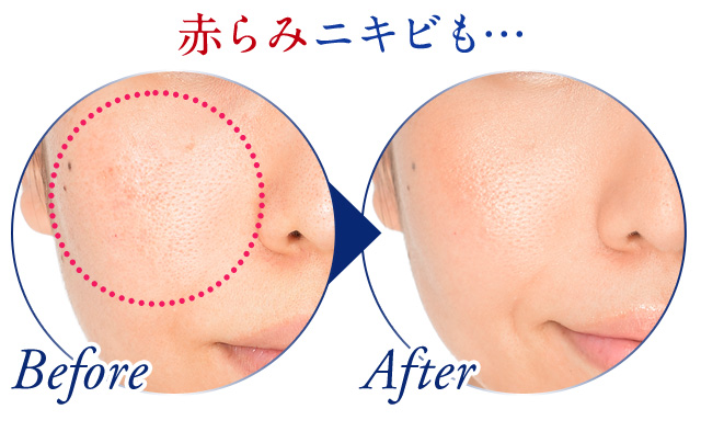 赤らみニキビも…